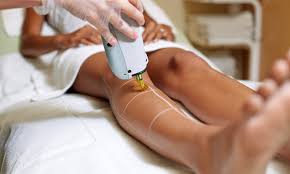 Laser Sessions